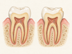 Cross-section comparison of two teeth: one with intact but demineralized enamel showing a white spot near the gum, and one with worn, chipped enamel exposing the dentin beneath, showing that weakened enamel can recover while lost enamel cannot regrow.