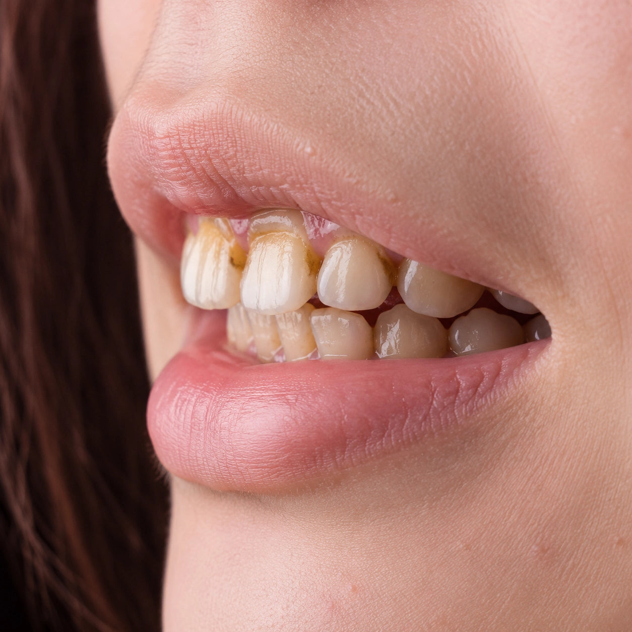 mouth with tartar and plague