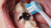 Proactive Plaque Defense video